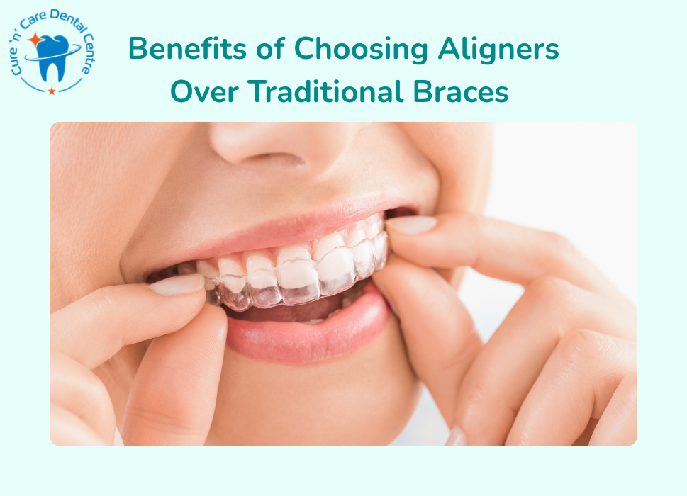 tooth aligners