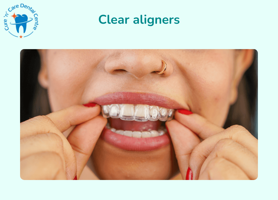 aligners