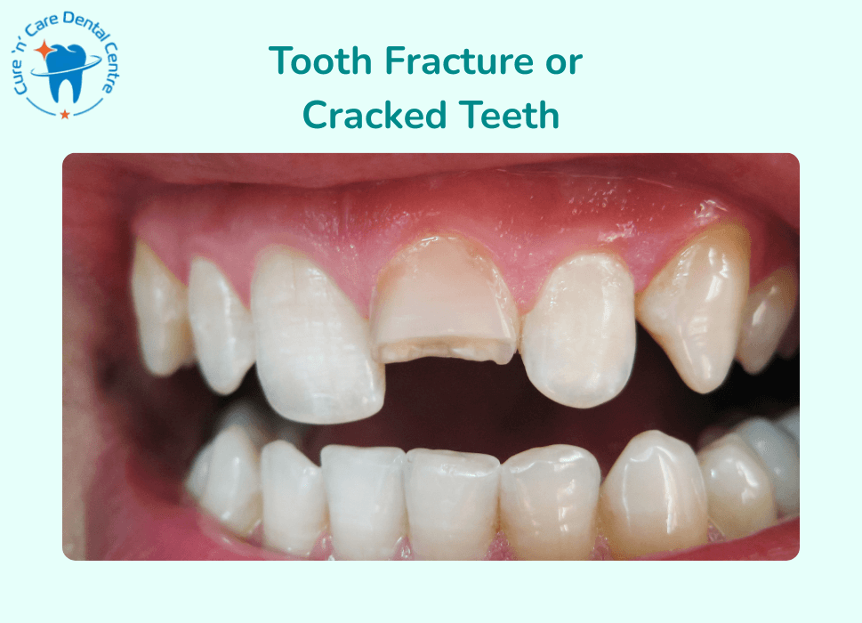 Tooth crack