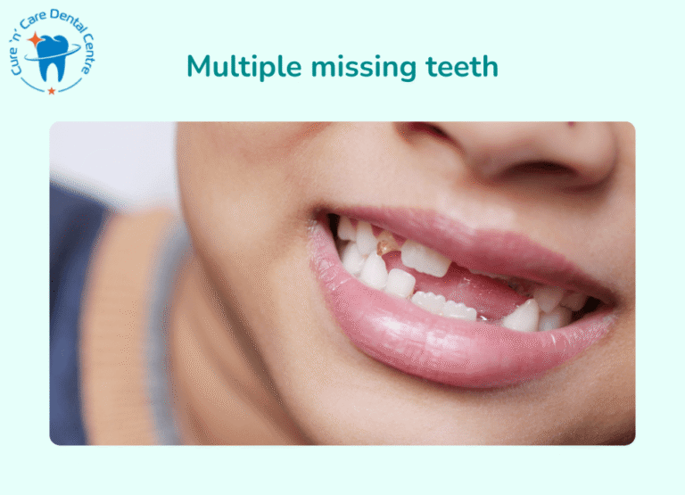Multiple missing teeth