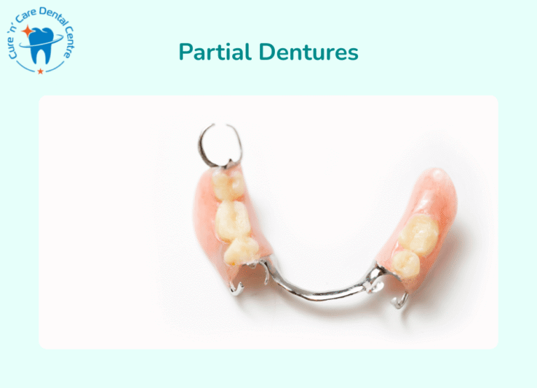 Partial Dentures