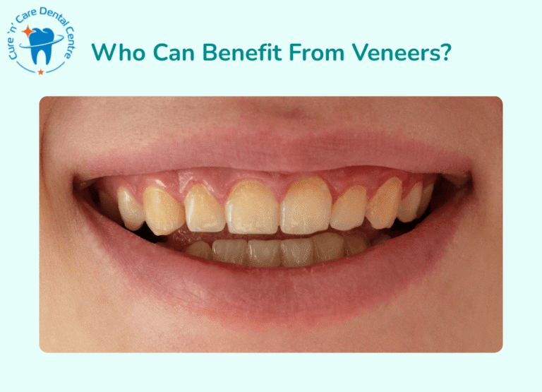 Teeth Veneers