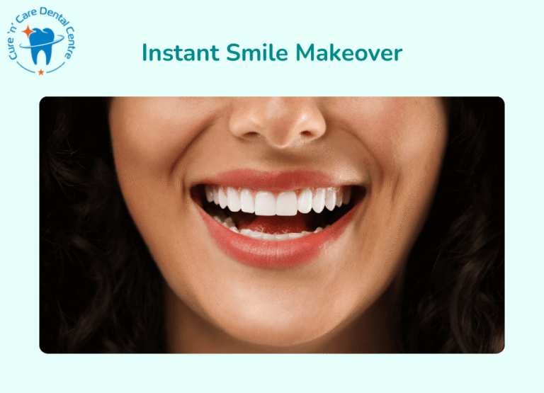 Teeth Veneers