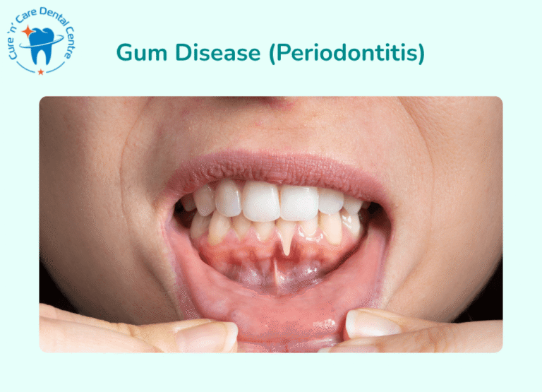 Gum Disease
