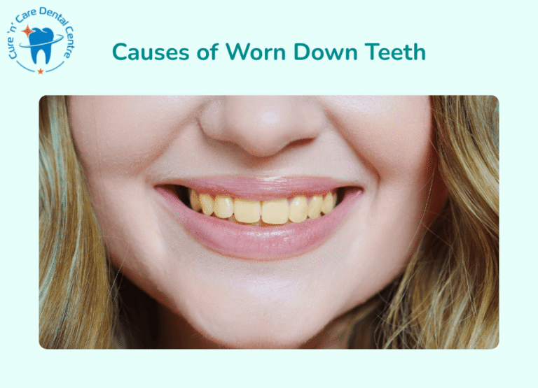 Causes of Worn Down Teeth