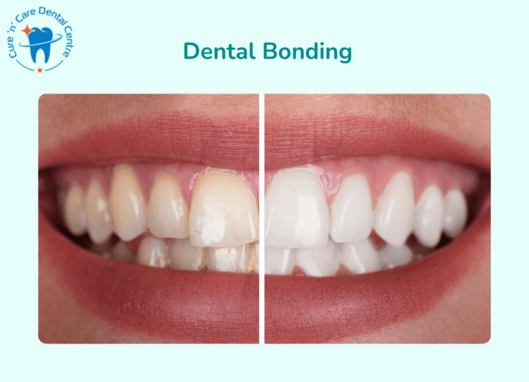 Tooth Build-Up Dental Bonding of Worn Down Teeth
