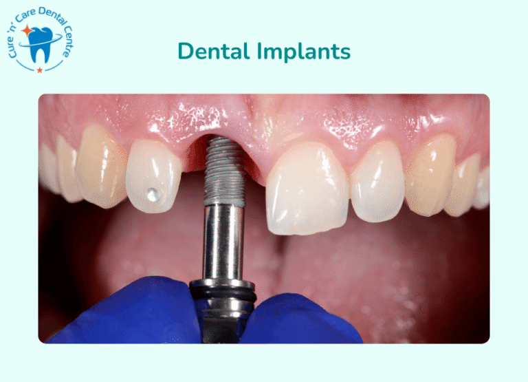 Dental Implants