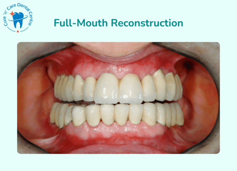 Full-Mouth Reconstruction