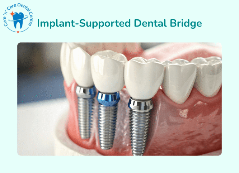 Implant-Supported Teeth Bridges