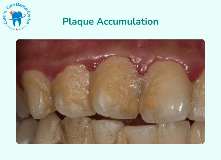 Plaque Accumulation