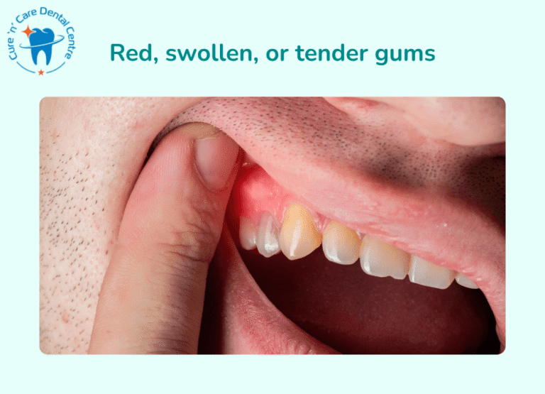 Signs and Symptoms of Gum Disease Red, swollen, or tender gums