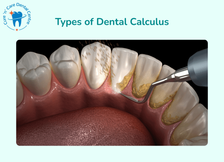 Dental Calculus types