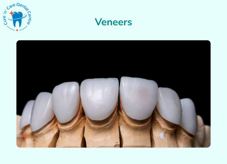 Veneers Tooth Build-Up